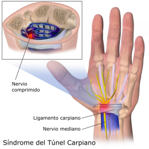 Sindrome-del-tunel-carpiano.-Blausen.com-staff.-Blausen-gallery-2014.-Wikiversity-Journal-of-Medicine..png_116527209
